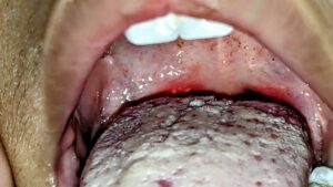 vesicular sore in oral cavity in Herpangina