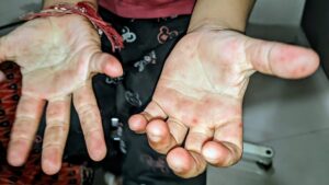 macular, maculopapular, or vesicular rash in hands in hand foot mouth disease