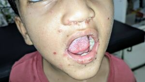macular, maculopapular, or vesicular rash on face