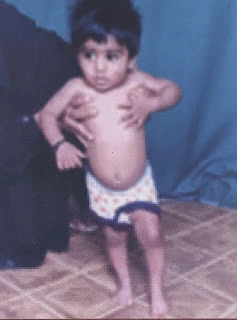 4 yrs boy with limping on left side and acute falccid paralysis due to polio(baccho ka tika chart)