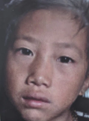 a girl have a rashes on face and red eys due to measles
