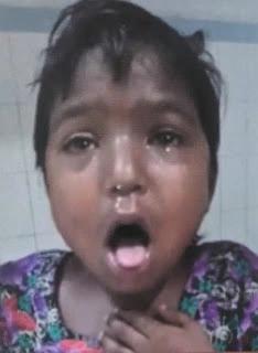 a girl has coughing and red eyes due to purtussis