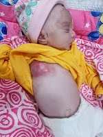newborn breast abscess