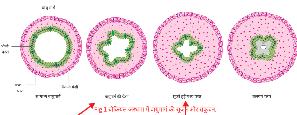 png of Airway-inflammation-and-narrowing-in-bronchial-asthma.