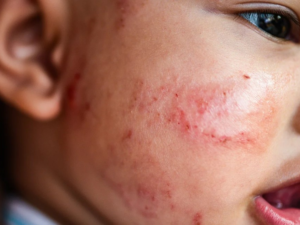 newborn baby with atopic dermatitis