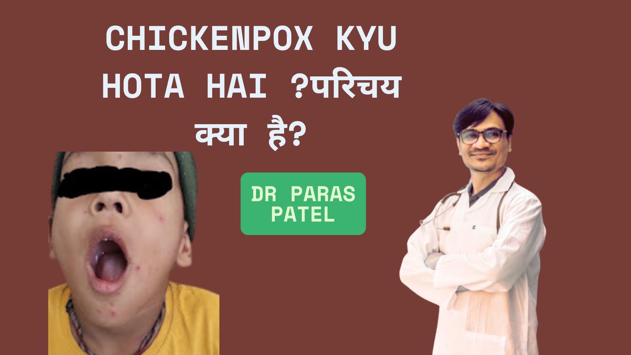varicella in children by dr paras png