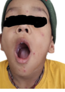 vericella rashes vesicles on a face of a child