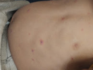 Chickenpox rashes on trunk of a child