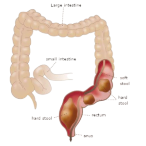 a case of constipation png suggests imapcted hard stool in gut